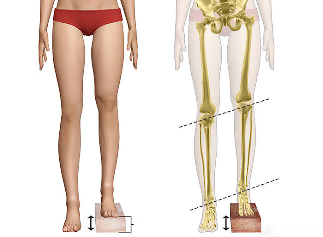 Leg Length Discrepancy